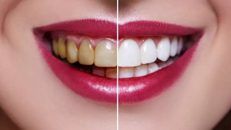 Teeth Whitening Treatment