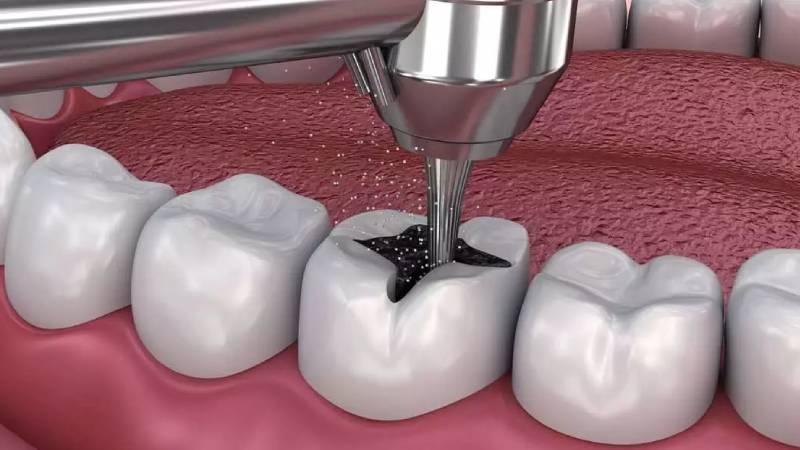 Conservative Dental Treatment