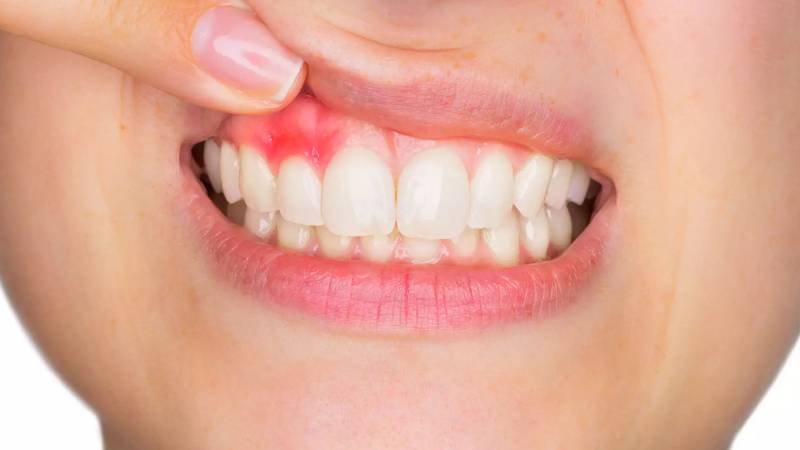 Gum Diseases (Periodontology)