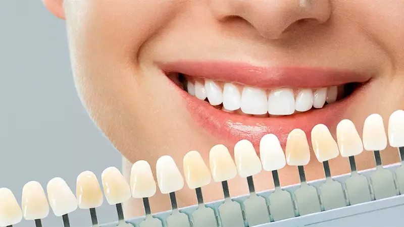 Zirconium Dental Veneers